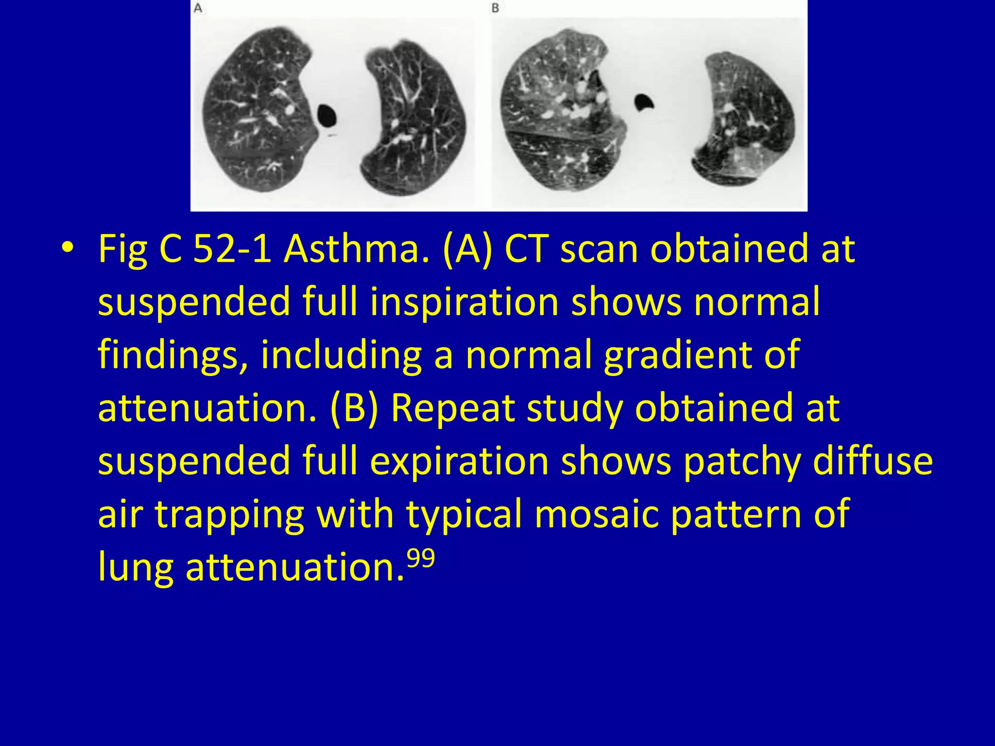 • Fig C 52-1 Asthma. (A) CT scan obtained at
suspended full inspiration shows normal
findings, including a normal gradient of
attenuation. (B) Repeat study obtained at
suspended full expiration shows patchy diffuse
air trapping with typical mosaic pattern of
lung attenuation.99