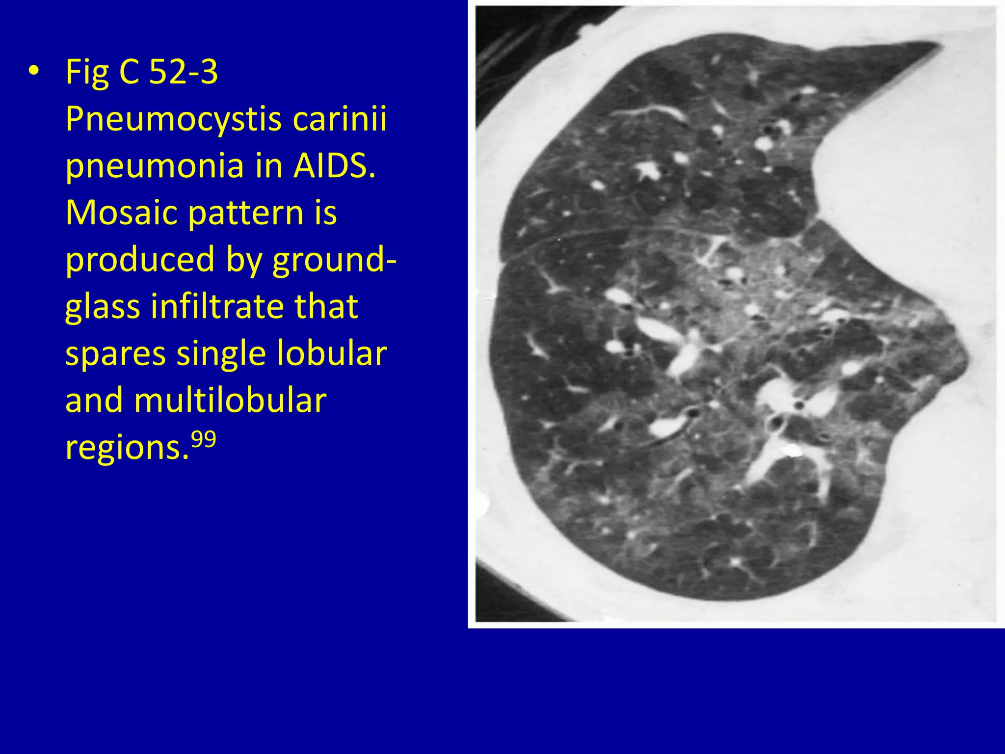 • Fig C 52-3
Pneumocystis carinii
pneumonia in AIDS.
Mosaic pattern is
produced by ground-
glass infiltrate that
spares single lobular
and multilobular
regions.99