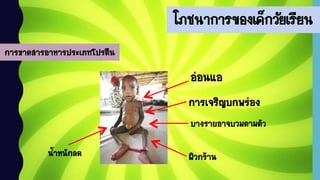 โภชนาการของเด็กวัยเรียน
การขาดสารอาหารประเภทโปรตีน
การเจริญบกพร่อง
น้าหนักลด
บางรายอาจบวมตามตัว
ผิวกร้าน
อ่อนแอ
 