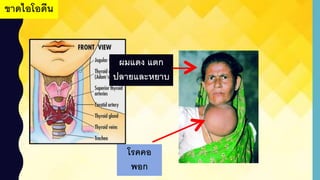 ขาดไอโอดีน
โรคคอ
พอก
ผมแดง แตก
ปลายและหยาบ
 