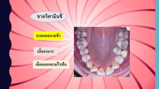 ขาดวิตามินซี
เลือดออกตามไรฟัน
เบื่ออาหาร
บาดแผลหายช้า
 