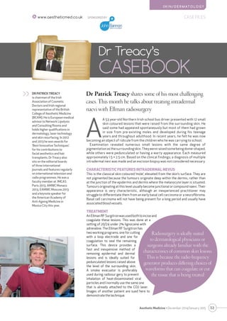 SKIN/DERMATOLOGY 
53 
Aesthetic Medicine • December 2014/January 2015 
SPONSORED BY 
CASE FILES 
www.aestheticmed.co.uk 
Dr Patrick Treacy shares some of his most challenging cases. This month he talks about treating intradermal naevi with Ellman radiosurgery 
Dr Treacy’s 
CASEBOOK 
DR PATRICK TREACY 
is chairman of the Irish Association of Cosmetic Doctors and Irish regional representative of the British College of Aesthetic Medicine (BCAM). He is European medical advisor to Network Lipolysis and Consulting Rooms and holds higher qualifications in dermatology, laser technology and skin resurfacing. In 2012 and 2013 he won awards for ‘Best Innovative Techniques’ for his contributions to facial aesthetics and hair transplants. Dr Treacy also sits on the editorial boards of three international journals and features regularly on international television and radio programmes. He was a faculty member at IMCAS 
Paris 2013, AMWC Monaco 2013, EAMWC Moscow 2013 
and a keynote speaker for 
the American Academy of 
Anti-Ageing Medicine in 
Mexico City this year. 
>> 
AA 53 year-old Northern Irish school bus driver presented with 12 small skin coloured lesions that were raised from the surrounding skin. He said some had appeared spontaneously but most of them had grown in size from pre-existing moles and developed during his teenage years and throughout adulthood. In recent years, he felt he was now becoming an object of ridicule from the children who he was carrying to school. 
Examination revealed numerous small lesions with the same degree of pigmentation as the surrounding skin. They were raised some being dome-shaped, while others were pedunculated or having a warty appearance. Each measured approximately 1.5 × 2.5 cm. Based on the clinical findings; a diagnosis of multiple intradermal nevi was made and an excision biopsy was not considered necessary. 
CHARACTERISTIC FEATURES INTRADERMAL NEVUS 
This is the classical skin-coloured ‘mole’, elevated from the skin’s surface. They are not pigmented because the tumours originate deep within the dermis, rather than at the junction of the epidermis and dermis where the melanocyte layer is situated. Tumours originating at this level usually become junctional or compound naevi. Their appearance is very characteristic, although an inexperienced practitioner may struggle to differentiate them from an early basal cell carcinoma or a neurofibroma. Basal cell carcinoma will not have being present for a long period and usually have associated blood vessels. 
TREATMENT 
An Ellman RF Surgitron was used both to incise and coagulate these lesions. This was done at a setting of 20/24 under 2% lignocaine with adrenaline. The Ellman RF Surgitron has two working programs, one for cutting with a loop electrode and one for coagulation to seal the remaining surface. This device provides a fast and inexpensive method of removing epidermal and dermal lesions and is ideally suited for pedunculated lesions raised above the level of the surrounding skin. A smoke evacuator is preferably used during radiosur gery to prevent inhalation of heat-disseminated viral particles and I normally use the same one that is already attached to the CO2 laser. Images of another patient are sued here to demonstrate the technique. 
Radiosurgery is ideally suited to dermatological physicians or surgeons already familiar with the characteristics of common skin lesions. This is because the radio-frequency generator produces differing choices of waveforms that can coagulate or cut the tissue that is being treated  