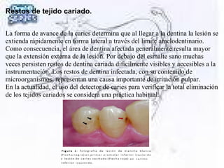 Restos de tejido cariado.
La forma de avance de la caries determina que al llegar a la dentina la lesión se
extienda rápidamente en forma lateral a través del limite amelodentinario.
Como consecuencia, el área de dentina afectada generalmente resulta mayor
que la extensión externa de la lesión. Por debajo del esmalte sano muchas
veces persisten restos de dentina cariada difícilmente visibles y accesibles a la
instrumentación. Los restos de dentina infectada, con su contenido de
microorganismos, representan una causa importante de irritación pulpar.
En la actualidad, el uso del detector de caries para verificar la total eliminación
de los tejidos cariados se considera una práctica habitual.
 