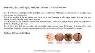Profª Mestra Janne Jéssica S. 76
Para efeito de classificação, a celulite pode ser classificada como:
Grau 1: os furinhos só são percebidos quando a pele é comprimida. Pode aparecer até mesmo nas crianças, sendo
mais comum nas adolescentes.
Grau 2: os furinhos já são percebidos sem comprimir a pele. Passando a mão sobre a pele, já se percebe uma
ondulação, sendo possível sentir alguns nódulos.
Grau 3: os nódulos são bastante perceptíveis e têm consistência endurecida, demonstrando que já houve formação
de fibrose. Pode haver dor local.
Grau 4: idem grau três porém ainda mais acentuada a aparência de casca de laranja . A pessoa refere muita
sensibilidade de dor ao toque do massagista em conduta de massagem estética. Considerada irreversível
Realizar drenagem linfática
 