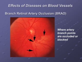 Branch Retinal Artery Occlusion (BRAO)
Where artery
branch points
are occluded or
blocked
Effects of Diseases on Blood Vessels
 