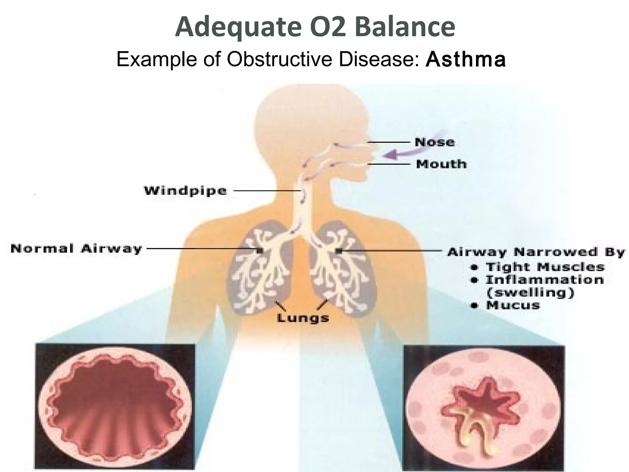 Adequate O2 Balance
    Example of Obstructive Disease: Asthma


•
 