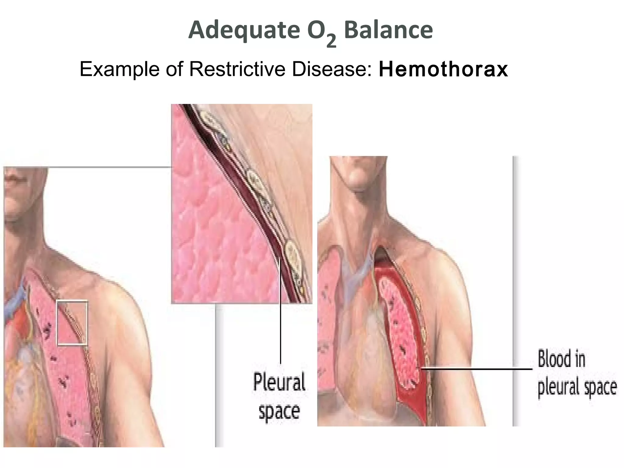 Adequate O2 Balance
    Example of Restrictive Disease: Hemothorax


•
 