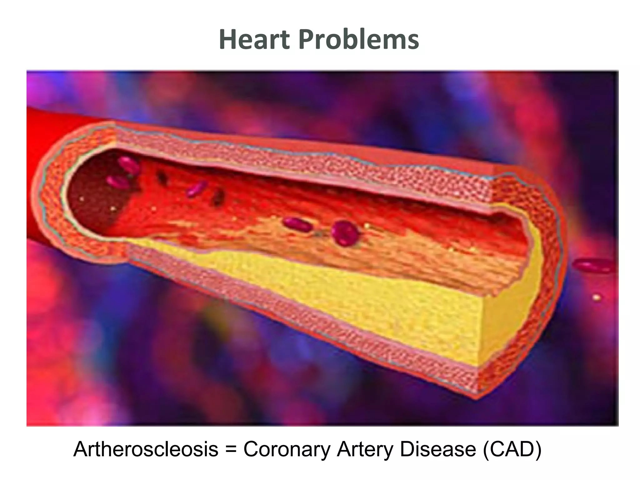 Heart Problems




Artheroscleosis = Coronary Artery Disease (CAD)
 