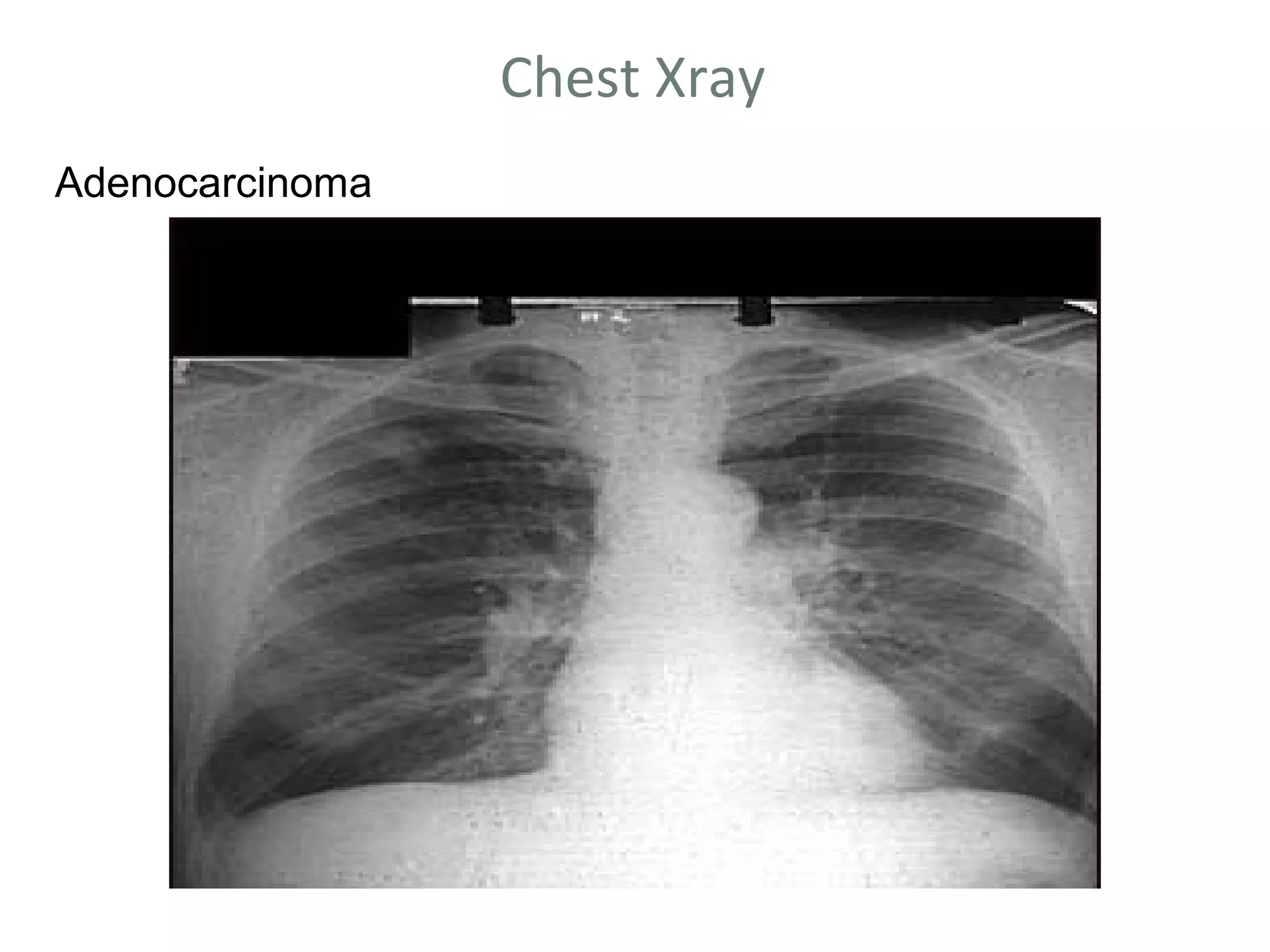Chest Xray
Adenocarcinoma
 