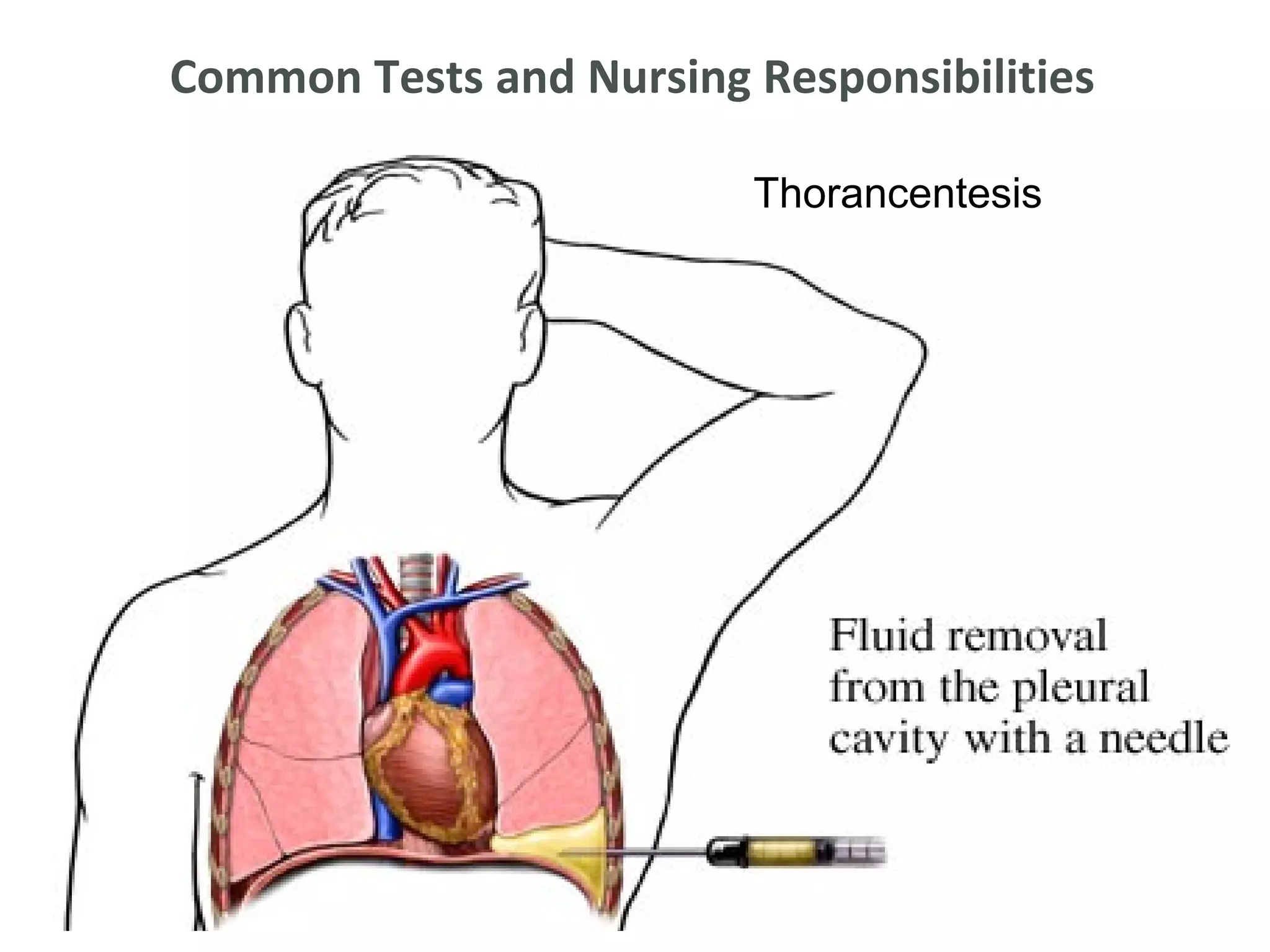 Common Tests and Nursing Responsibilities

                         Thorancentesis
 