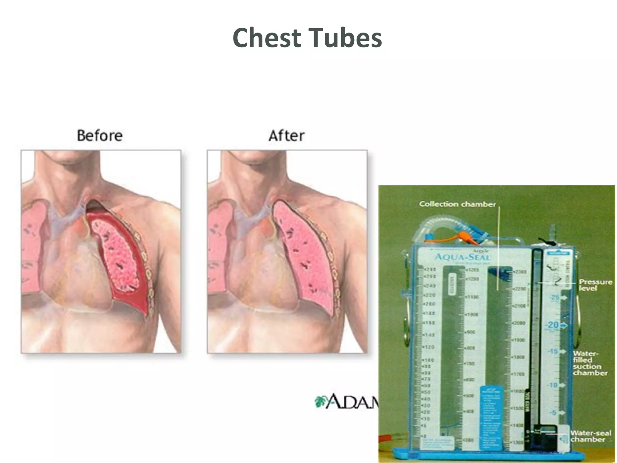 Chest Tubes
 