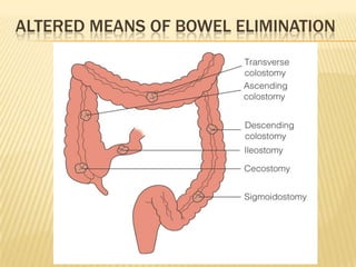 ALTERED MEANS OF BOWEL ELIMINATION
 