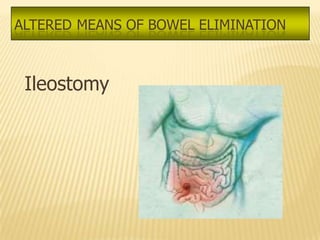ALTERED MEANS OF BOWEL ELIMINATION



 Ileostomy
 