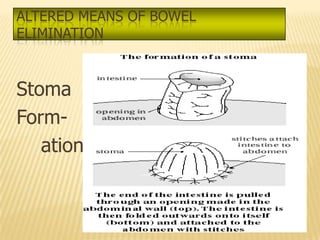 ALTERED MEANS OF BOWEL
ELIMINATION



Stoma
Form-
   ation
 