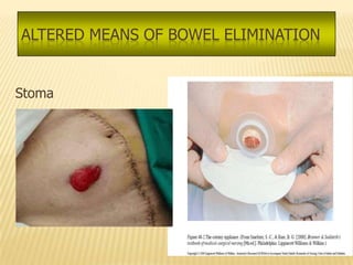 ALTERED MEANS OF BOWEL ELIMINATION


Stoma
 