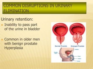 COMMON DISRUPTIONS IN URINARY
    ELIMINATION

Urinary retention:
   Inability to pass part
    of the urine in bladder

   Common in older men
    with benign prostate
    Hyperplasia
 