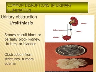 COMMON DISRUPTIONS IN URINARY
     ELIMINATION
Urinary obstruction
    Urolithiasis

-   Stones calculi block or
    partially block kidney,
    Ureters, or bladder

-   Obstruction from
    strictures, tumors,
    edema
 