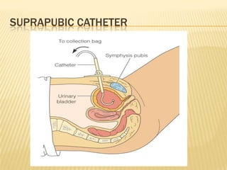 SUPRAPUBIC CATHETER
 