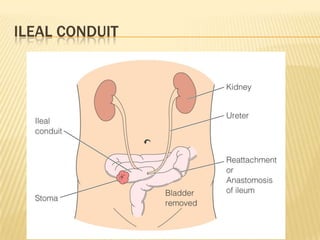 ILEAL CONDUIT
 