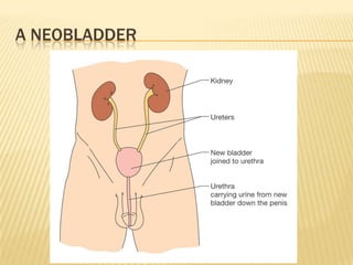 A NEOBLADDER
 