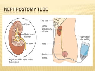 NEPHROSTOMY TUBE
 