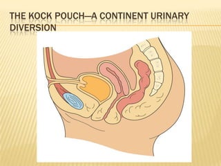 THE KOCK POUCH—A CONTINENT URINARY
DIVERSION
 