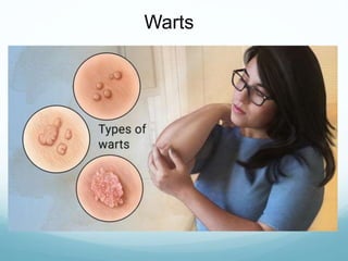 Warts
 