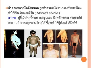  ถาตอมหมวกไตดานนอก ถูกทําลายจะไมสามารถสรางฮอรโมน
 ทําใหเปน โรคแอดดิสัน ( Addison’s disease )
 อาการ ผูที่เปนโรคนี้รางกายจะซูบผอม ผิวหนังตกกระ รางกายไม
 สามารถรักษาสมดุลของแรธาตุได ซึ่งจะทําใหผูปวยเสียชีวิตได
 