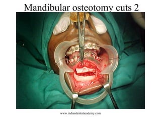 Mandibular osteotomy cuts 2
www.indiandentalacademy.com
 