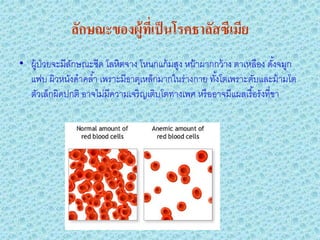 ลักษณะของผู้ทเี่ ป็ นโรคธาลัสซีเมีย
• ผู้ป่วยจะมีลกษณะซีด โลหิตจาง โหนกแก้ มสูง หน้ าผากกว้ าง ตาเหลือง ดังจมูก
              ั                                                          ้
  แฟบ ผิวหนังดําคลํ ้า เพราะมีธาตุเหล็กมากในร่างกาย ทังโตเพราะตับและม้ ามโต
                                                      ้
  ตัวเล็กผิดปกติ อาจไม่มีความเจริ ญเติบโตทางเพศ หรื ออาจมีแผลเรื อรังที่ขา
                                                                 ้
 