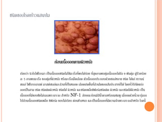 ชนิดของโรคท้าวแสนปม




                                 ก้อนเนื้องอกตามผิวหนัง
                                                         ่     ่ ่
    เรียกว่า นิวโรไฟโบรมา เป็ นเนื้องอกชนิดไม่ใช่มะเร็งทีพบได้บอย ทีสุดอาจพบตุมเนื้องอกได้ถึง 9 พันตุม ผูป่วยร้อย
                                                                              ่                       ่ ้
                            ่ ่
    ละ 5 อาจพบมะเร็ง ของตุมทีผิวหนัง หรือมะเร็งเม็ดเลือด ตัวเนื้องอกประกอบด้วยเซลล์หลาย ชนิด ได้แก่ ชวานน์
    เซลล์ ไฟโบรบลาสต์ มาสต์เซลล์และส่วนทีเ่ ป็ นหลอด เลือดเกิดขึ้นทีสวนใดของเส้นประสาทก็ได้ โดยทัวไปจัดแบ่ง
                                                                     ่่                             ่
    ออกเป็ นสาม ชนิด ชนิดติดผิวหนัง ชนิดใต้ ผิวหนัง และชนิดเพล็กซิฟอร์มชนิดติด ผิวหนัง และชนิดใต้ผิวหนัง เป็ น
    เนื้องอกทีมขอบชัดไม่เฉเฉพาะเจาะจง สําหรับ NF-1 ลักษณะก้อนมีสนาตาลหรืออมชมพู เมื่อกดด้วยนิ้วจะบุมลง
              ่ี                                                         ี ํ้                                ๋
                                                                                ่ี
    ไปส่วนเนื้องอกชนิดเพล็ก ซิฟอร์ม ขอบไม่เรียบ ค่อนข้างหนา และเป็ นเนื้องอกทีมความจําเพาะเจาะจงสําหรับ โรคนี้
 