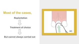 Most of the cases,
Replantation
Treatment of choice
But cannot always carried out
 