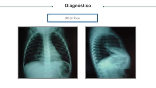 Diagnóstico
RX de Torax
 