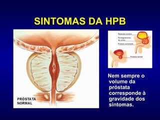 SINTOMAS DA HPB Nem sempre o volume da próstata corresponde à gravidade dos sintomas.  