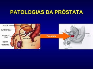 PATOLOGIAS DA PRÓSTATA Prostata 