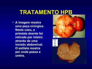 TRATAMENTO HPB A imagem mostra uma peça cirúrgica. Neste caso, a próstata doente foi retirada por inteiro através de uma incisão abdominal. O estilete mostra por onde passa a uretra. 