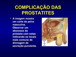 COMPLICAÇÃO DAS PROSTATITES A imagem mostra um corte da pelve masculina. Observar um abscesso da próstata com setas indicando os locais mais comuns de drenagem da secreção purulenta. 