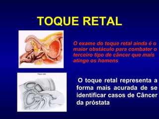 TOQUE RETAL O toque retal representa a forma mais acurada de se identificar casos de Câncer da próstata O exame do toque retal ainda é o maior obstáculo para combater o terceiro tipo de câncer que mais atinge os homens   