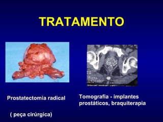 TRATAMENTO     Prostatectomia radical  ( peça cirúrgica) Tomografia - implantes prostáticos, braquiterapia                                                          