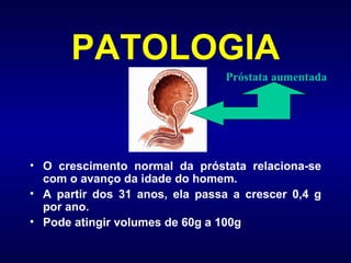 PATOLOGIA O crescimento normal da próstata relaciona-se com o avanço da idade do homem.  A partir dos 31 anos, ela passa a crescer 0,4 g por ano. Pode atingir volumes de 60g a 100g Próstata aumentada 