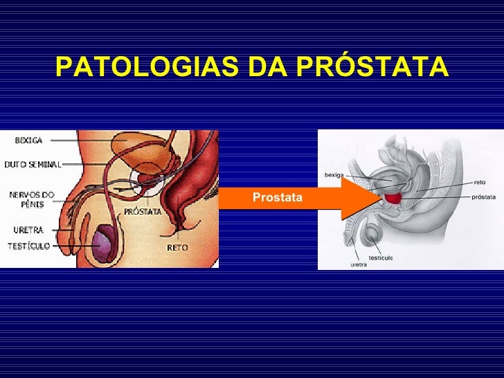 A Patologia Da Prostata