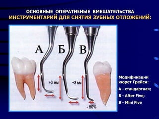 ОСНОВНЫЕ ОПЕРАТИВНЫЕ ВМЕШАТЕЛЬСТВА
ИНСТРУМЕНТАРИЙ ДЛЯ СНЯТИЯ ЗУБНЫХ ОТЛОЖЕНИЙ:
Модификации
кюрет Грейси:
А - стандартная;
Б - After Five;
В - Mini Five
 