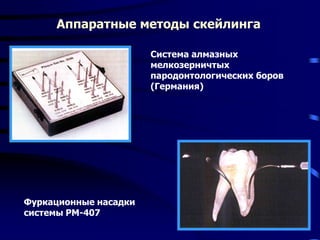 Аппаратные методы скейлинга
Система алмазных
мелкозерничтых
пародонтологических боров
(Германия)
Фуркационные насадки
системы РМ-407
 