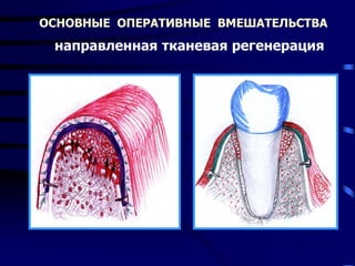 ОСНОВНЫЕ ОПЕРАТИВНЫЕ ВМЕШАТЕЛЬСТВА
направленная тканевая регенерация
 