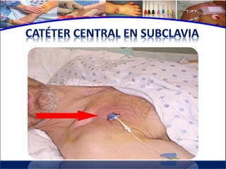 Cuidados de enfermería en accesos venosos - CICAT-SALUD