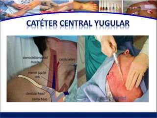 Cuidados de enfermería en accesos venosos - CICAT-SALUD