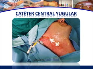 Cuidados de enfermería en accesos venosos - CICAT-SALUD