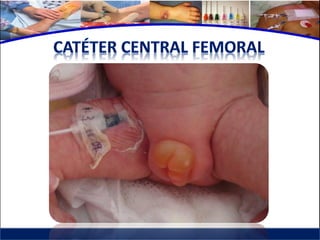 Cuidados de enfermería en accesos venosos - CICAT-SALUD