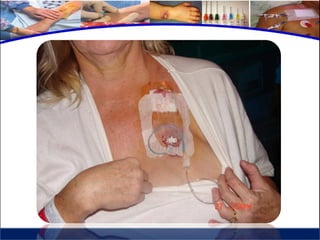 Cuidados de enfermería en accesos venosos - CICAT-SALUD