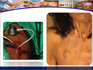 Cuidados de enfermería en accesos venosos - CICAT-SALUD
